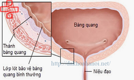 bieu-hien-viem-bang-quang