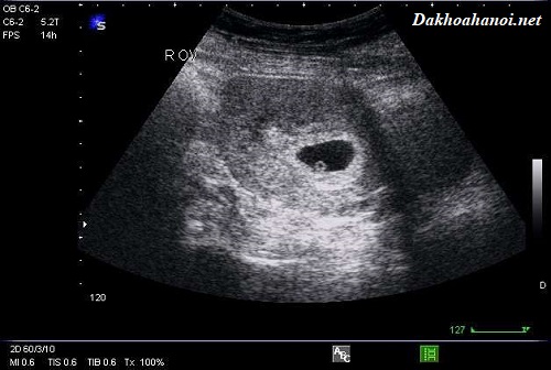 Hình ảnh siêu âm thai 6 tuần tuổi