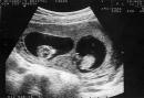 hình ảnh siêu âm thai đôi 4 tuần