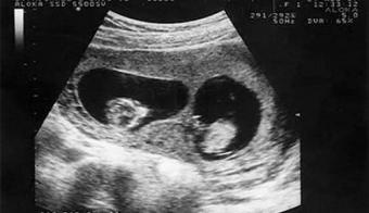 hình ảnh siêu âm thai đôi 4 tuần