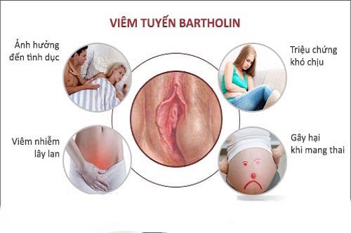 nguy hiểm viêm tuyến Bartholin khi mang thai
